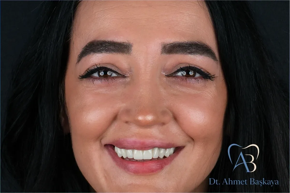 Zirconia Dental Crowns in Bursa