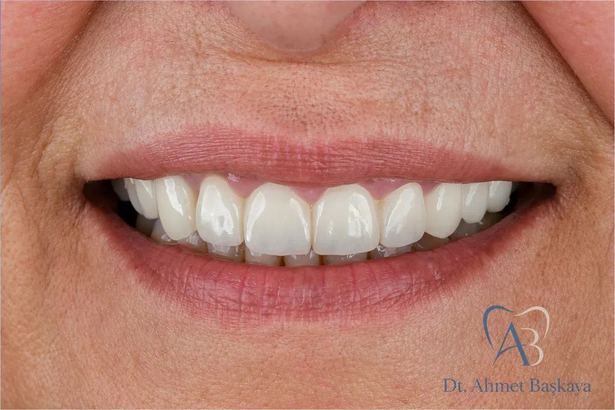 Dental Implant Prices in Bursa 2026: Factors Affecting Prices and a Treatment Guide