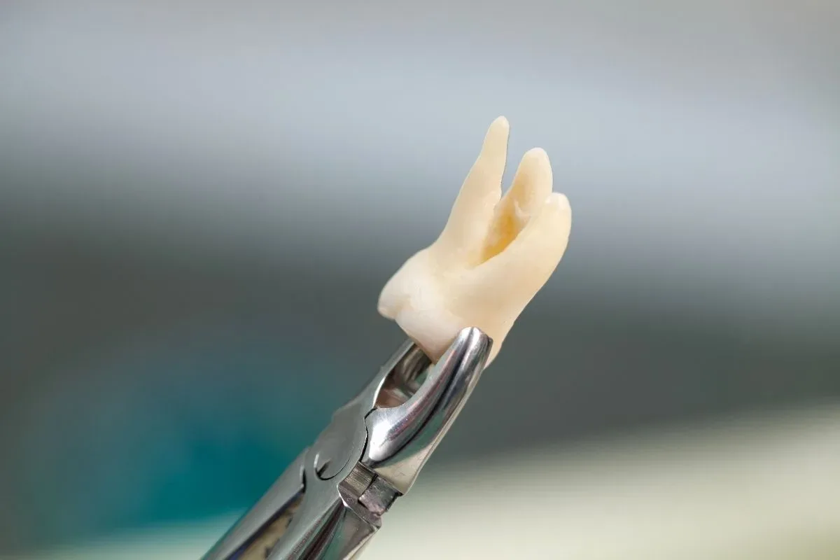 Wisdom Tooth Extraction: Wisdom Tooth Treatment and the Extraction Process in Bursa