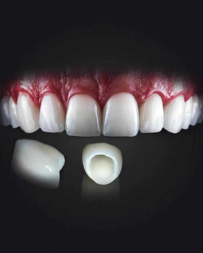Bursa E-Max Veneer: Features, Application Areas, and Treatment Process