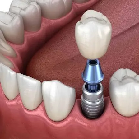 Long-Term Implant Success in Diabetes Patients: Risks and Success Factors