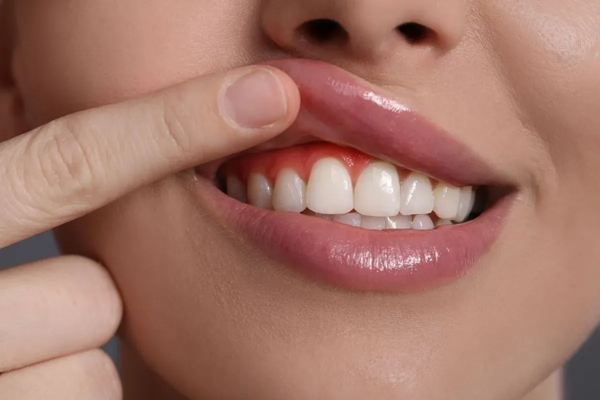 Bursa Diş Eti Tedavisi: Diş Eti Sağlığı ve Periodontal Tedavi Rehberi